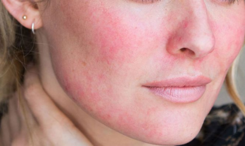 7 Tips Mencegah Masalah Kulit akibat Menggunakan Masker