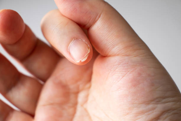 The nails are crack nails.