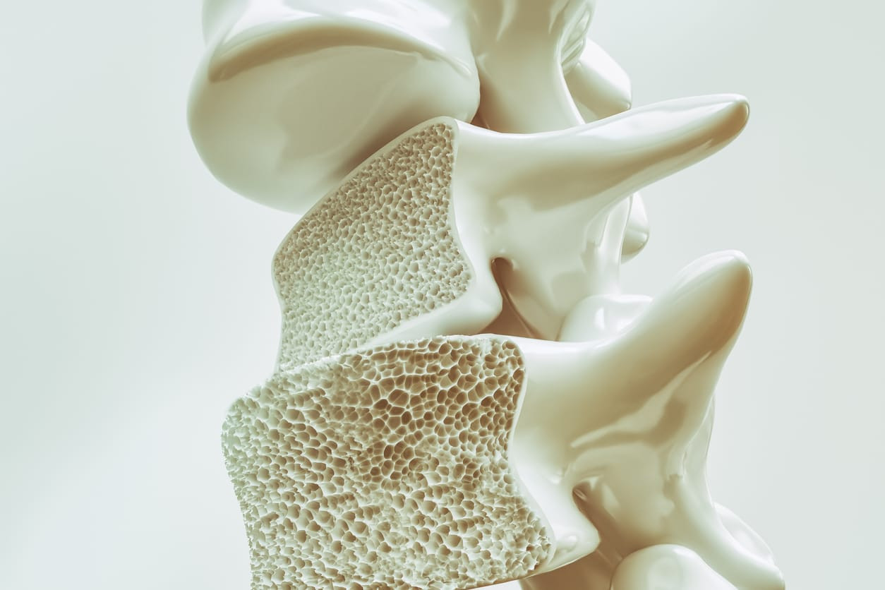 Bukan Hanya Usia, Kenali Penyebab Osteoporosis dan 4 Cara Mencegahnya