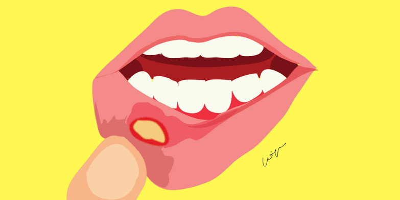 cara pengobatan sariawan di lidah