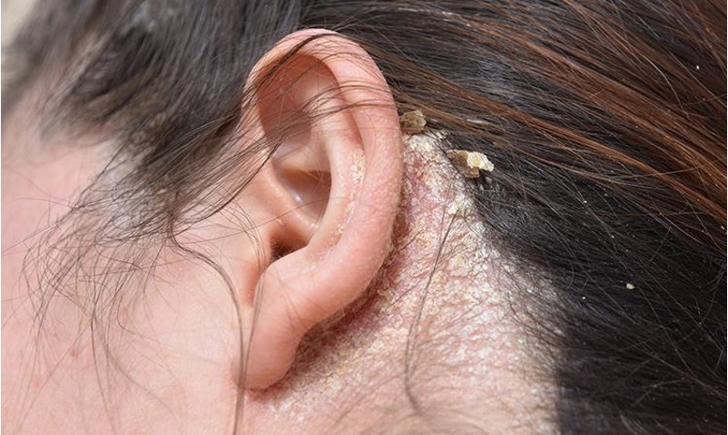 Penyebab Dermatitis Seboroik dan Cara Mengatasinya | Bisa Bikin Kulit Kepala Bersisik
