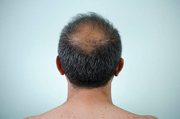 9 Cara Cepat Menumbuhkan Rambut Botak dalam 1 Minggu