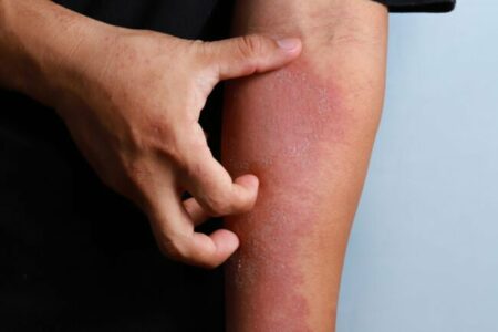 Penyakit kulit dermatitis