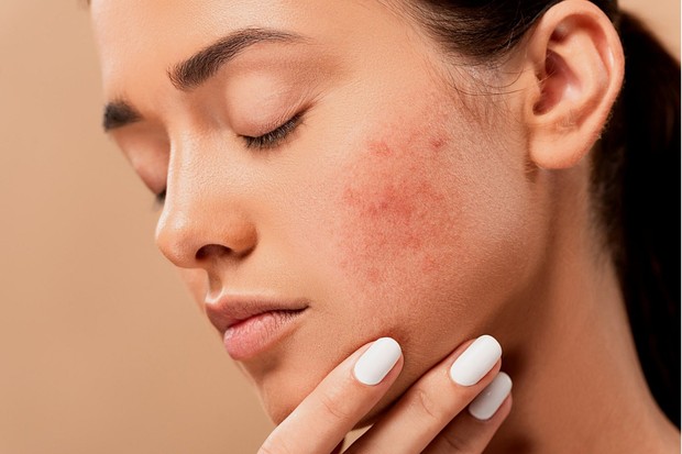 Beda dengan Jerawat, Kenali Ciri-ciri dan Cara Mengobati Rosacea