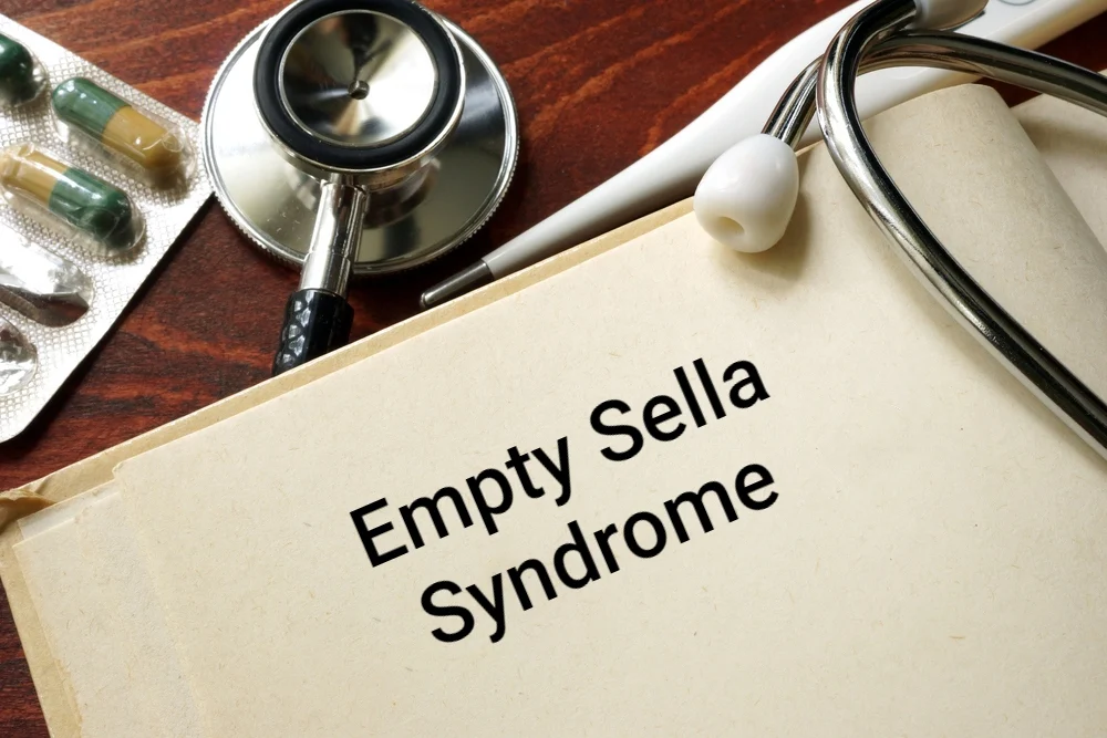 Apa Itu Penyakit Empty Sella Syndrome? Kenali Gejala Kondisi Langka yang Diidap Ruben Onsu