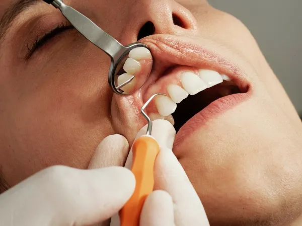 10 Cara Membersihkan Karang Gigi yang Sudah Mengeras Secara Alami