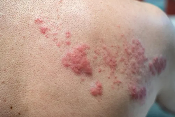 9 Pantangan Penyakit Herpes, Biar Nggak Makin Parah!