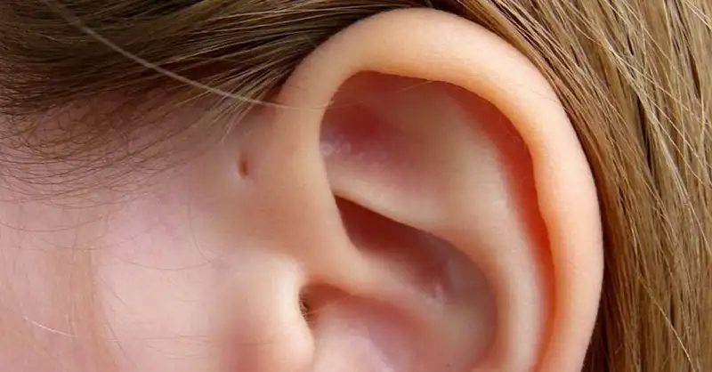lubang-kecil-di-atas-telinga