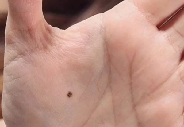 Penyebab dan Arti Tahi Lalat di Telapak Tangan Kiri | Tips Agar Tidak Bertambah