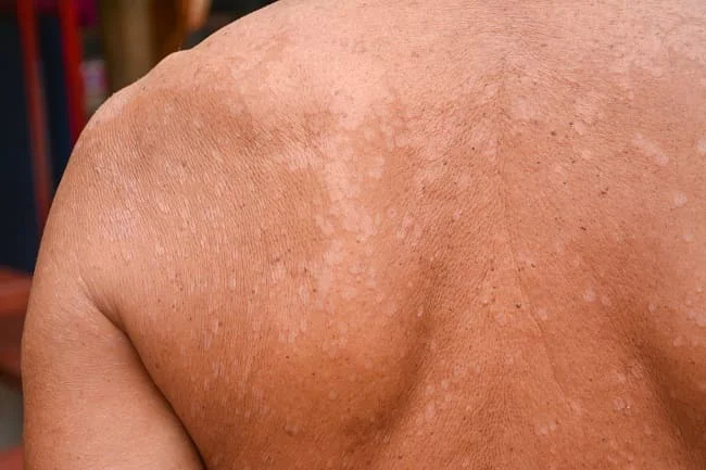 Tinea Versicolor, Penyakit Jamur yang Mengganggu Kulit Manusia